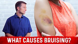 What Causes Bruising Without Trauma – Dr Berg [upl. by Dustman]