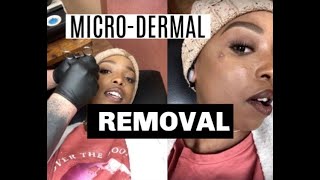 MicroDermal Piercing Removal  Piercing Update [upl. by Pettifer]