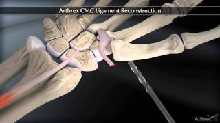 Arthrex CMC Ligament Reconstruction [upl. by Ettenor118]