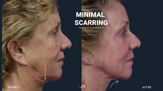 CO2 Fractional Laser Resurfacing  Before and After Video  Dr David Stoker [upl. by Aicertap823]