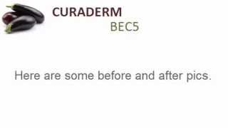 What is Curaderm How To Use Curaderm amp Before and After Pictures [upl. by Kavanaugh]