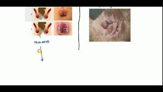 Hemorrhoids Lecture for USMLE [upl. by Neltiac]