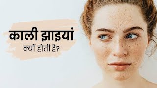 चेहरे की झाई  remove pigmentation  remedy of melasma  elocon cream  Freckles face  Jhaiya [upl. by Fiske]