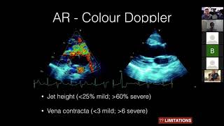 Aortic Regurgitation [upl. by Rainwater]