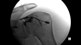 ORTHOMED Shoulder Injection under Fluoroscopic [upl. by Traci437]