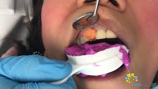 Cosmetic Dental Crown Procedure  All Ceramic Crown [upl. by Tnarud]