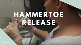 Hammertoe Tendon Release [upl. by Frederica]