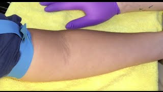 Tips For Locating Difficult Veins [upl. by Artema]