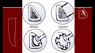 Osteomyelitis Acute and Chronic [upl. by Adnih]