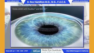 LASIK  Refractive Surgery  understand the procedure [upl. by Shipley7]