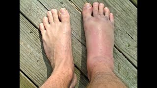 SPRAINED or BROKEN Ankle  Doctor Guide [upl. by Hollingsworth]