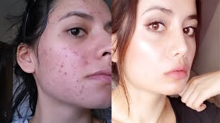 Tretinoin Before and After 12 Tips To Get The BEST RESULTS [upl. by Gord515]